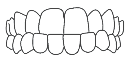 Mya My Aligner Maloclusion Anteroposterior
